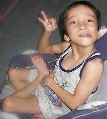 Paralisiscerebral